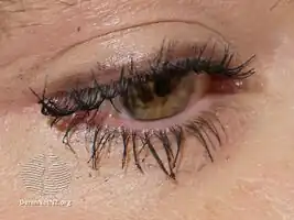 Effect of bimatoprost solution on eyelashes