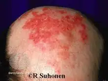 Effects of fluorouracil cream applied to actinic keratoses
