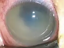 Endophthalmitis caused by H. influenzae