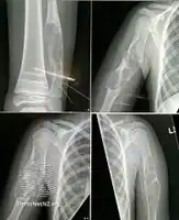Epidermal nevus syndrome-skeletal defects