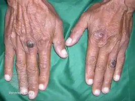 Epidermolysis bullosa acquisita
