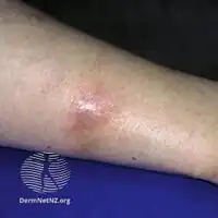 Erythema induratum