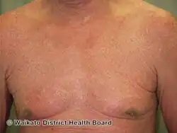 Erythrodermic psoriasis before ustekinumab