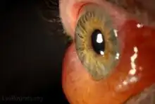 Severe chemosis of the lower conjunctiva due to thyroid eye disease.