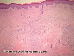 Necrobiotic xanthogranuloma-pathology