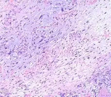 Myxofibrosarcoma-pathology