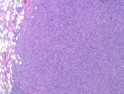 Myxofibrosarcoma-pathology