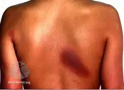 Fixed drug reaction to cotrimoxazole