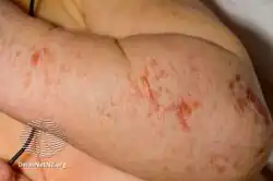 Focal dermal hypoplasia