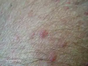 Folliculitis