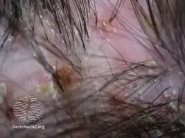 Folliculitis decalvans