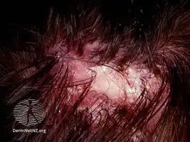 Folliculitis decalvans