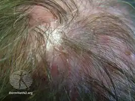 Folliculitis decalvans