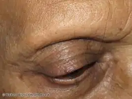 Frontal fibrosing alopecia