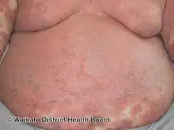 Generalised pustular psoriasis