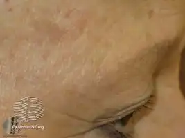 Graham Little syndrome.