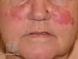Granuloma faciale
