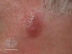 Granuloma faciale