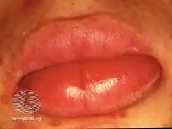 Granulomatous cheilitis