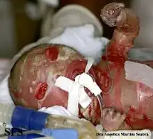 Harlequim Ichthyosis