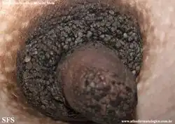 Hyperkeratosis of nipple and areola