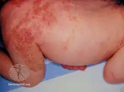 Incontinentia pigmenti