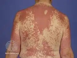 Interstitial granulomatous dermatitis