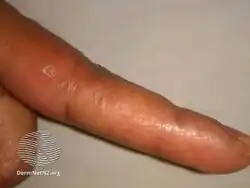 Keratoelastoidosis marginalis