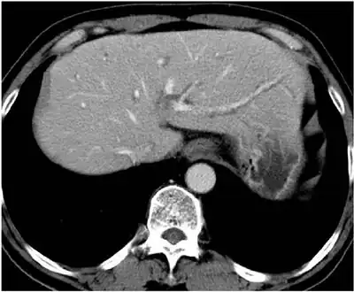 CT of individual with clonorchiasis