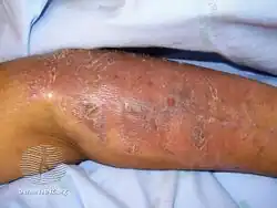 Lichenoid drug eruption