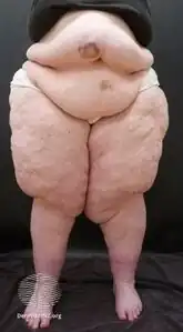 Lipoedema stage III