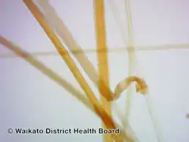 Loose anagen syndrome