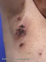 Lymphomatoid papulosis type E