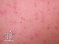 Malassezia folliculitis