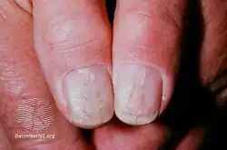 Median canaliform nail dystrophy of Heller