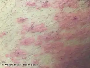 Morbilliform drug eruption