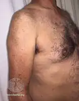 Multicentric reticulohistiocytosis