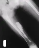 Myositis ossificans[2]