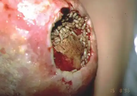 After applications of maggots, wound is free of slough and rich with granulation tissue[61]