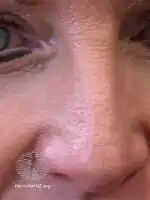 One month after MAL PDT