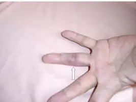 Osler node on ring finger of left hand