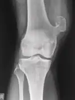 Osteochondroma[1]