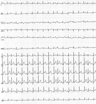 Junctional ectopic tachycardia