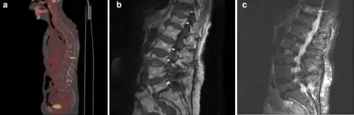 a) Sagittal fused FDG-PET/CT image demonstrates multiple compression fractures throughout the thoracic and lumbar spine b) sagittal MRI demonstrates multiple chronic compression fractures c) sagittal STIR image demonstrates mild edema in T11 compression fracture