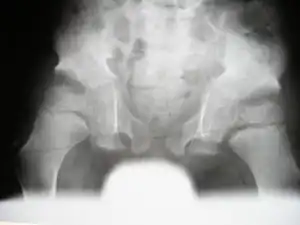 ( Marshall-Stickler overlap) Anteroposterior pelvis radiograph showed, coxa valga, a hypoplastic ileae, acetabulo-femoral and metaphyseal dysplasia