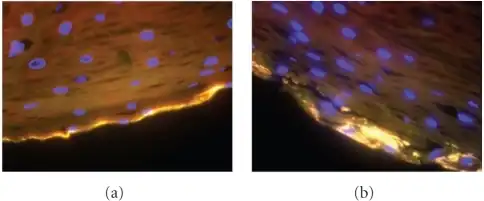 a,b) Gardnerella vaginalis biofilm is detected at the edge of the vaginal epithelium