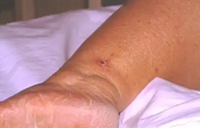 Typical appearance of Mediterranean spotted fever entrance site