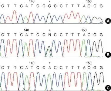 Wiskott-Aldrich Syndrome-a) Normal control b) sequencing identification of missense mutation in exon 2 of WAS gene, single base "G" to "A" substitution causing replacement of arginine by histidine c) WAS exon 2 sequence in female heterozygotes