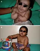 a) Radical club hand b) after surgery