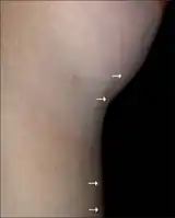 Lateral view-Mondor's disease